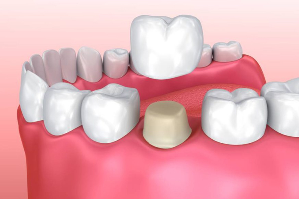 Dental Crown Carmel