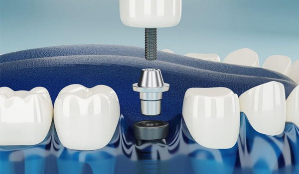Dental Implants Carmel