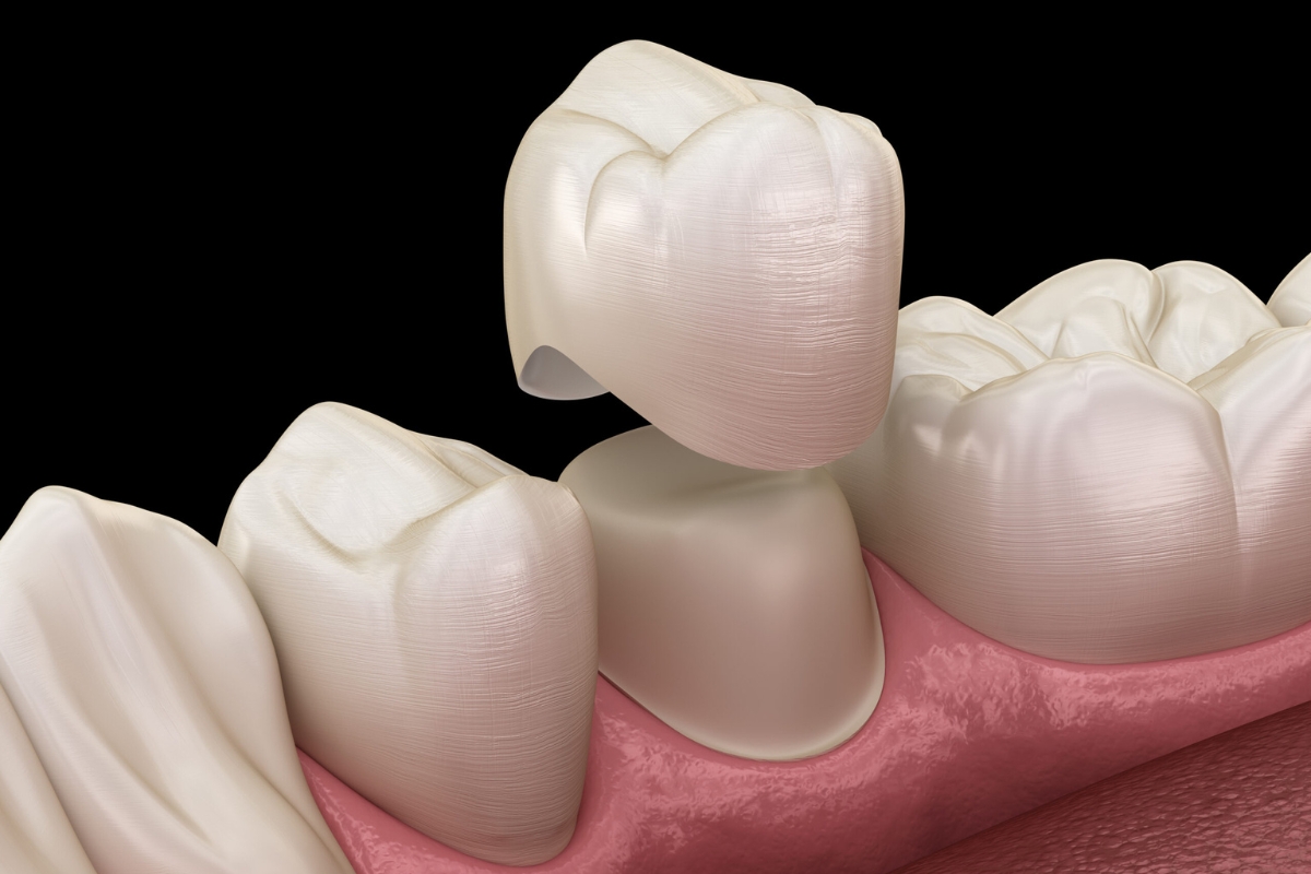 How Do Dental Crowns Affect Appearance of Your Smile