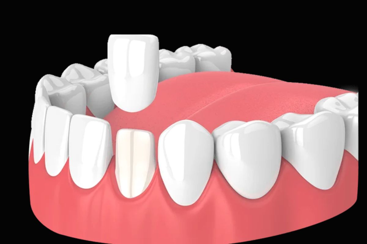 Choosing porcelain veneers