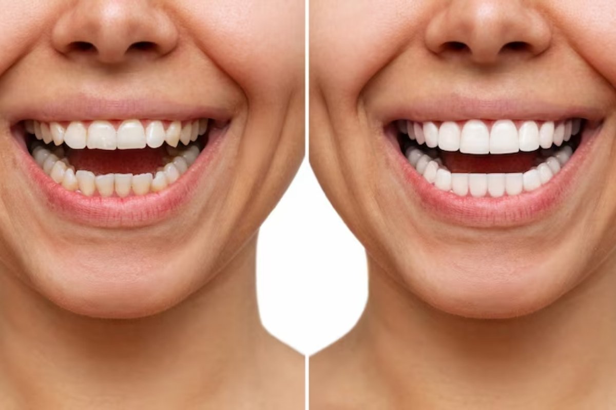 How Cosmetic Bonding Repairs Discolored & Chipped Teeth