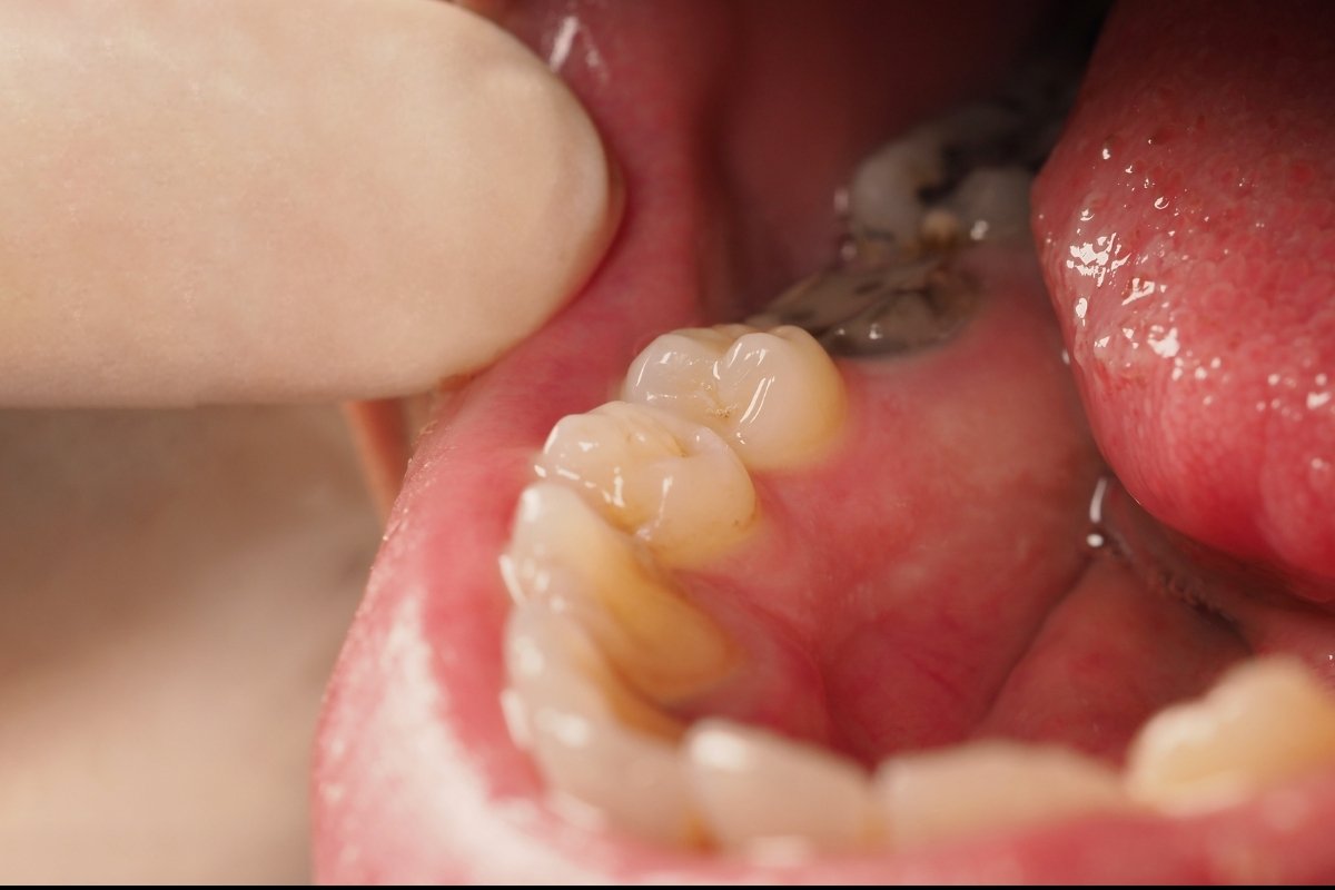 Early Tooth Decay Solutions: Detection & Treatment Explained