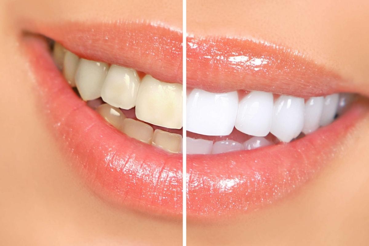 Keep Your Teeth White Between Whitening Treatments