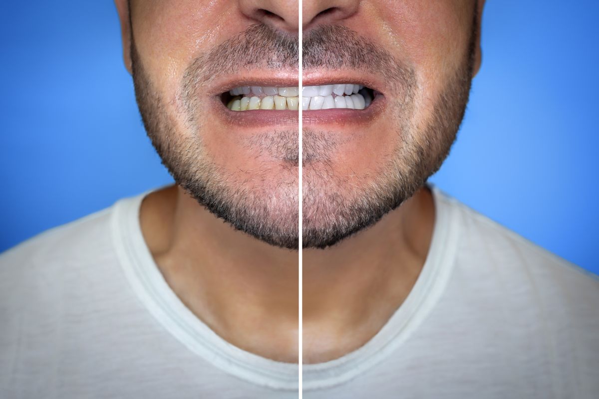 Cosmetic Bonding Candidacy